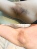 嫌なにおいをごっそり軽減★【わき脱毛】¥2,200
