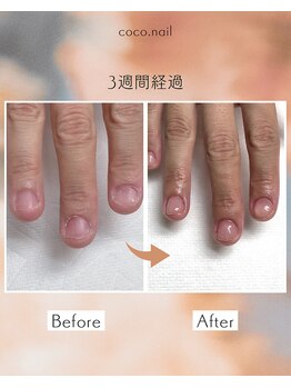 クリアジェル 爪噛み