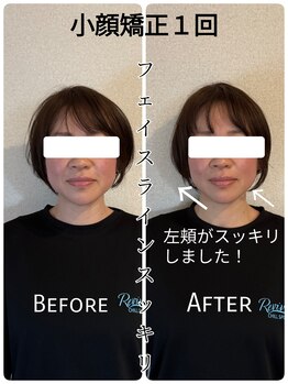 リバイブ 自由が丘店(REVIVE)/小顔矯正+ドライヘッドスパ1回