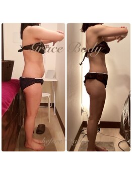痩身脱毛専門店 グレイスボディ MEGAドンキホーテ三郷店(Gracebody)/◆痩身　症例写真