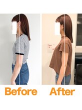 整体院ひなた 宮崎院/20代女性反り腰猫背改善