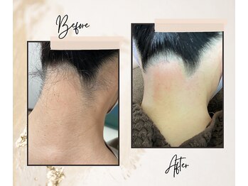 ミロクビューティーガーデン(MirokuBG)/襟足WAX脱毛