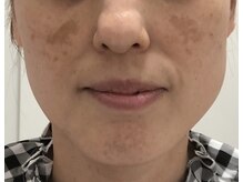 サロン ド アンジェリーナ(Salon de Angelina)/40代 レーザー跡の悩み(施術前)