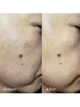 ユウユウ(YUYU)/純粋レチノールピール