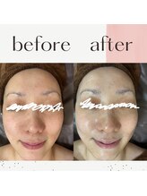 ミルル(milulu)/美白効果