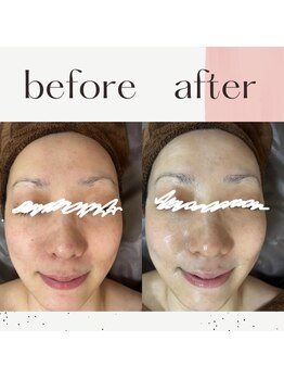 ミルル(milulu)/美白効果