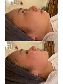 カランコエ(KALANCHOE)/肌艶UP!フェイスラインスッキリ