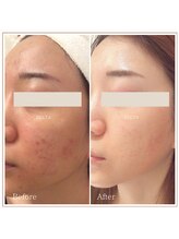 ベルタ(BELTA)/ケア前→6ヶ月後　ニキビ/肌荒れ