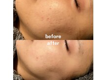 グレアージュ(GLEAGE)/ハーブピーリングで肌質改善！