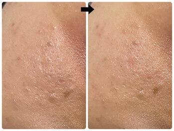 エフェクト 塚口店(effect)/Before After 20代/1回目