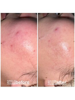 ミニョン(mignon)/お肌の赤み軽減！