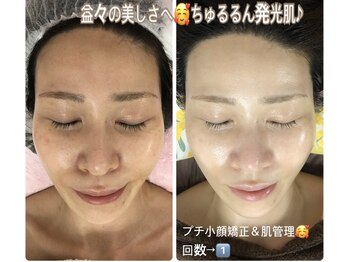 アルページュ(Arpege)/韓国ピール×水滴LDM×アンプル