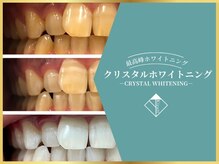 無加工の歯のビフォーアフターです◎至高のセルフホワイトニング