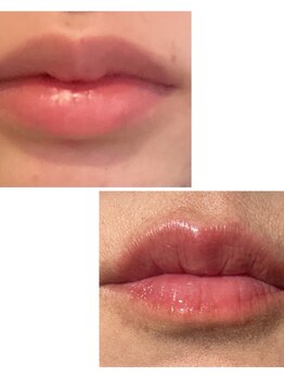 ココラッシュ(coco.lash)の写真/【しみ・くすみが気になる方必見★】話題の”LALAPINK”導入！お肌のお悩みに、韓国発の本格施術を熊本で♪