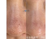 オウジエステサロン(OJIエステサロン)/40代女性　プロセル3回