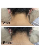 サロン ド チェリー 西町店(Salon de Cherry)/うなじ脱毛