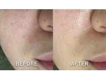 サロンドジェシカ(salon de Jessica)/毛穴洗浄フェイシャル