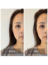 アウル なかもず店(OWL)/肌質改善ビフォーアフター