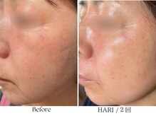 ビボーラ(BEBEAURA)/☆HARIトリートメント☆