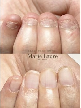 マリーロール 天王寺店(Marie Laure)/自爪育成/深爪矯正/ネイルケア