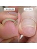 【巻き爪矯正プログラムの方はこちら】リピーターさま