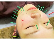 けん鍼きゅう整骨院/【美容鍼に興味ある方】