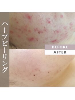 リラ(Lilas)/冷感ハーブピーリング