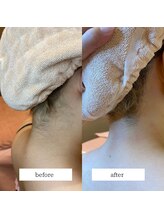 ミーティスジータ(mitis Gita)/うなじ脱毛