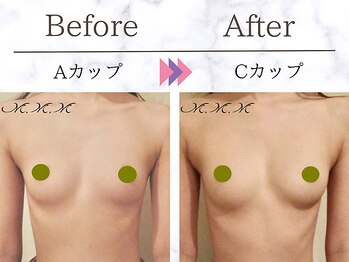 メディカルサロン エム エム エム 大阪梅田グランドサロン(M.M.M)/【バストアップ例】　A→Cカップ