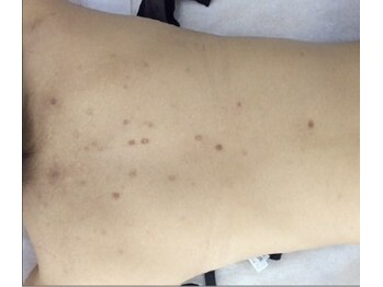 リベル 名古屋(Lebelle:)/名古屋 ハーブピーリング