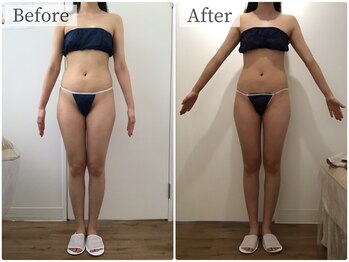 ボーレーヴ(beau reve)/ブライダル/インディバ/痩身