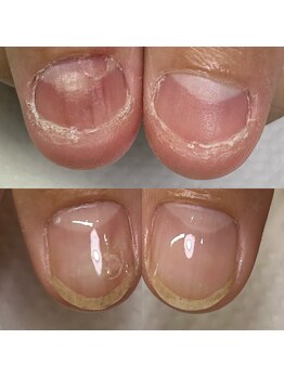 ハッチネイル(HACCI nail)/お客様Beforeafter