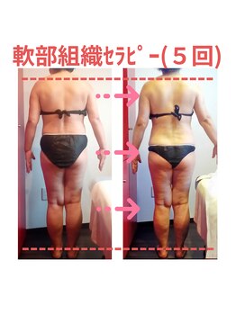 ビューティサロン キヨの部屋(beauty salon)/【軟部組織セラピー】週１回×５