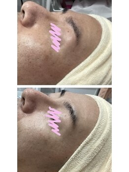 じゅえる/光フェイシャルの効果 次へ→