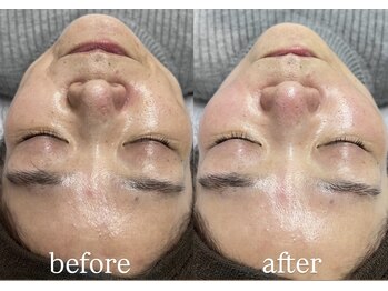 サロン ド グレース(Salon de Grace)/ヒト幹細胞培養上清液100%