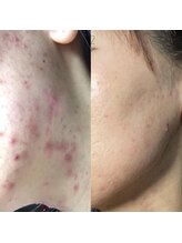 シエル(Ciel)/フェイシャル★ニキビ改善