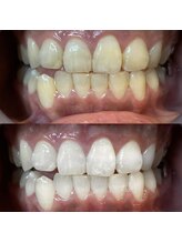 LBSホワイトニング 錦糸町店/ホワイトニングビフォーアフター