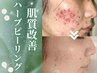 剥けるリベルハーブピーリング！1週間後のアフターケア付き
