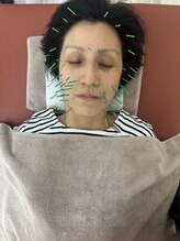 鍼灸サロン ヒマワリ(himawari)/美容鍼