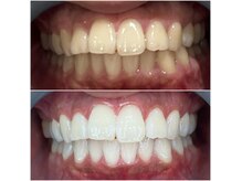 【医療提携ホワイトニング】で芸能人のような歯の白さに☆