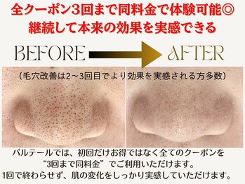 パルテール/頬の毛穴がお悩み