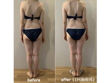 ルーシー(Lucy)/フォースカッター 施術