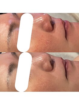 ジル(JilL)/ダクトピールビフォーアフター