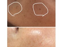 ベルフィーヌ ノーブル(BELLEFINE noble)/施術３回目でこんなに薄く