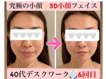 マール(Mar)/ビフォーアフター　小顔/たるみ