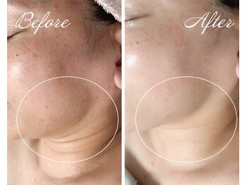 ルポ 鶴見(Repos)/シュっとした輪郭に★小顔ケア