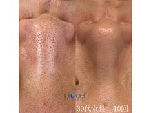 オウジエステサロン(OJIエステサロン)/30代女性　プロセル10回