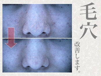 ザ フェース 梅田店(THE FAITH)/◆毛穴に詰まった角栓スッキリ◆