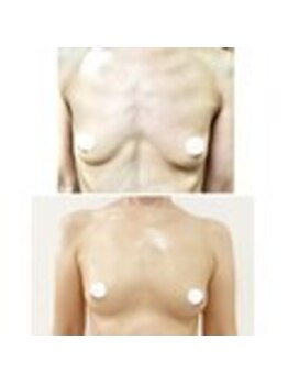 美人バスト 豊橋店/バストアップ症例【バストケア】