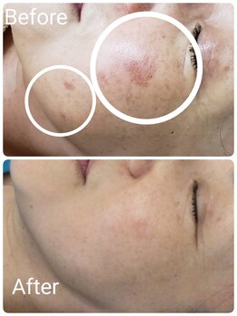 シェアキ(Chez Aki)/シミケアBefore/After